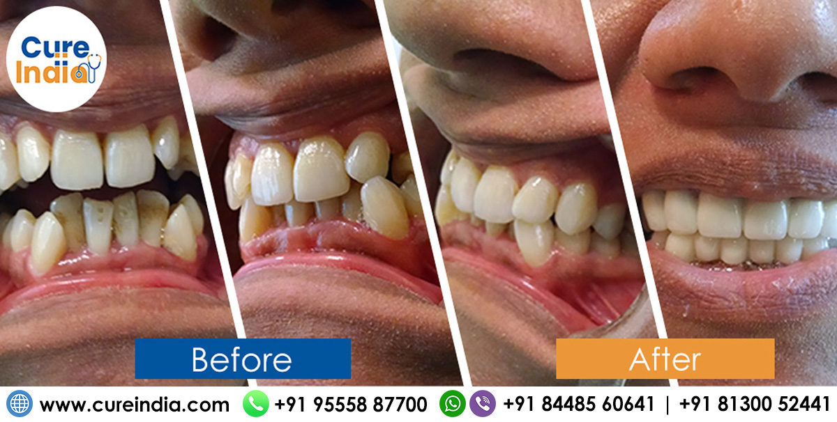 smile makeover before and after